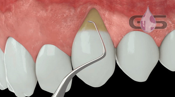 3D Demonstration | PeriAcryl®90