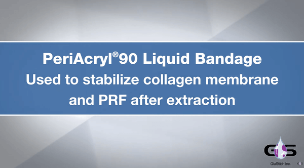 PeriAcryl® Adhesive Dressing Used to Stabilize Collagen Membrane and PRF Post Extraction